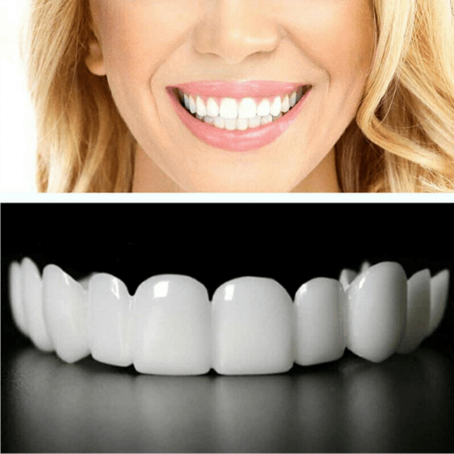 Виниры — декоративное покрытие зубов